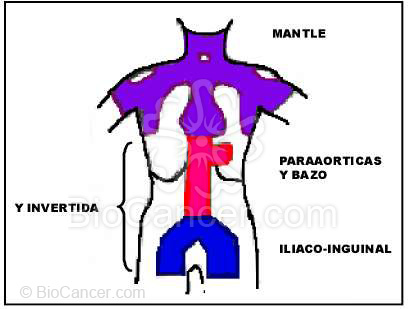 Principios generales del cáncer Linfomas: conducta biológica y principios del tratamiento Enfermedad De Hodgkin Tratamiento Radioterapia (rt)